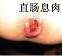 直肠息肉的症状