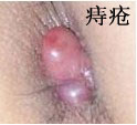 痔疮的症状图片