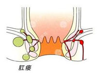肛瘘