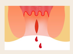 大便黑色是怎么回事