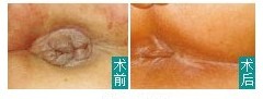 微创手术前后对比
