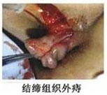 结缔组织外痔