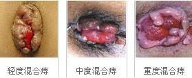 混合痔发展图