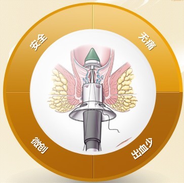 PPH优势