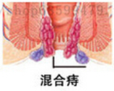 混合痔