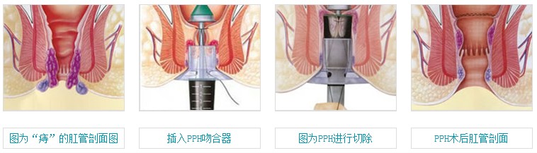 PPH治疗痔疮过程
