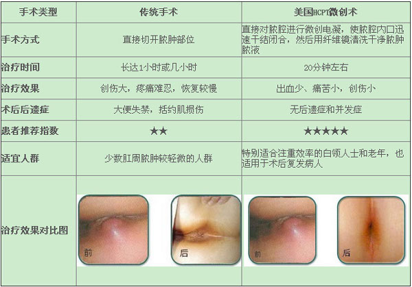 传统手术治疗肛瘘与微创手术治疗对比