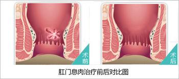 肛门息肉治疗前后对比图