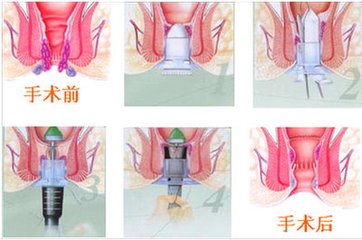 痔疮检查,检查痔疮