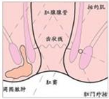 结核性肛瘘