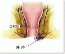 血栓外痔