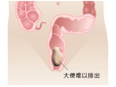 长期大便困难有哪些危害