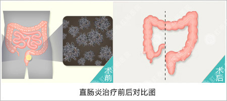 直肠炎治疗前后的对比图