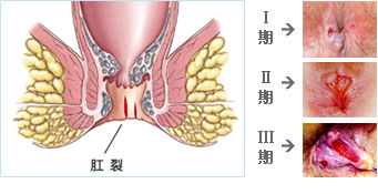 肛裂的症状是什么