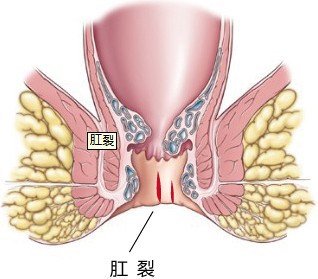 肛裂是怎么回事