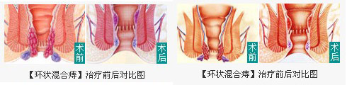 混合痔疮一定要做手术吗